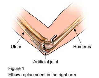 Elbow Replacement Surgery Bangalore